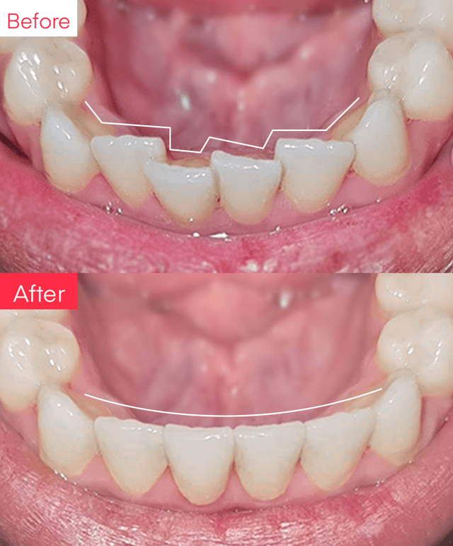 Before and After