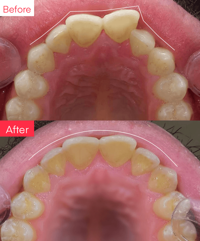 Before and After