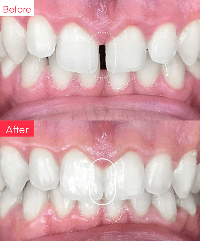 Before and After