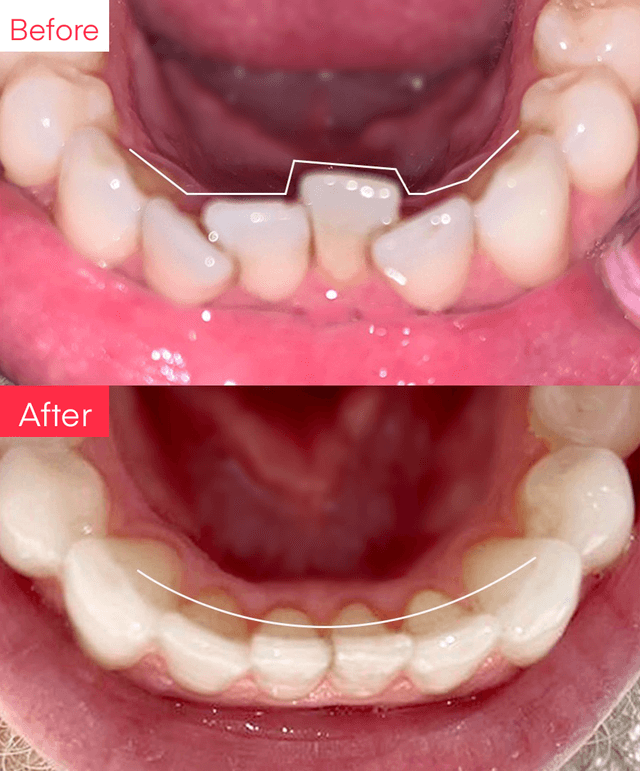Before and After
