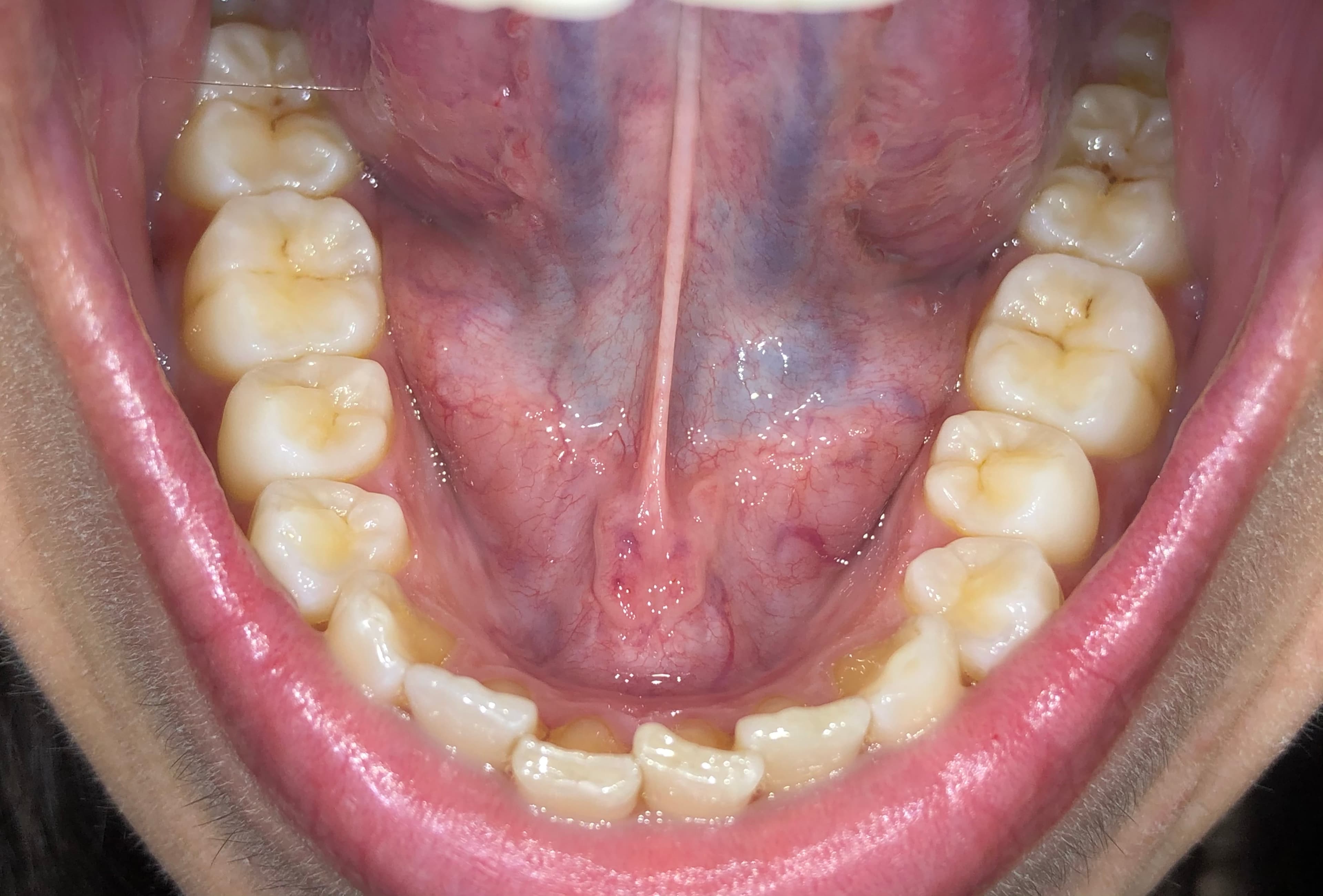 Beginning of treatment