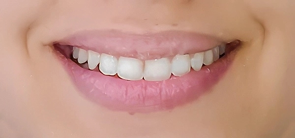 Invisible aligners treatment result showing straightened teeth