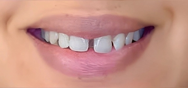 Invisible aligners treatment result showing straightened teeth